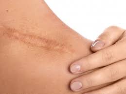 Beberapa tips ampuh mengatasi bekas luka pada kulit